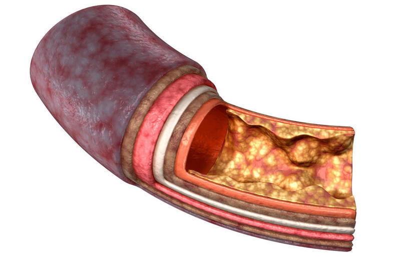 动脉,无人,横图,插画,室内,特写,白天,白色背景,正面,数码,科技,阴影,网络,医学,高光,几何,计算机图形,合成,图画,画,电脑合成图,数码合成图,疾病,生物学,漫画,生理学,写实,具体,具象,动脉硬化,血块,动脉管壁,彩图,血管壁