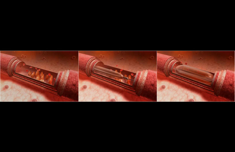 血管,无人,横图,插画,室内,白天,正面,数码,科技,静物,阴影,黑色背景,网络,红血球,医学,高光,几何,计算机图形,合成,图画,画,人体,电脑合成图,数码合成图,疾病,生物学,漫画,生理学,写实,具体,具象,动脉粥样硬化,白血球,彩图,血管壁