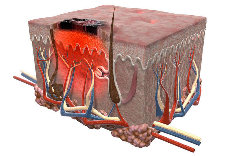 血管,无人,横图,插画,室内,特写,白天,白色背景,正面,数码,科技,静物,阴影,网络,医学,高光,几何,计算机图形,合成,图画,画,人体,皮肤,电脑合成图,数码合成图,生物学,漫画,真皮,生理学,写实,具体,具象,皮肤癌,彩图,黑色素瘤