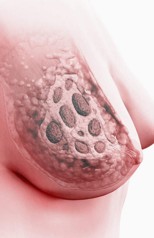 胸,无人,竖图,插画,室内,特写,白天,正面,数码,科技,静物,阴影,黑色背景,网络,医学,高光,几何,计算机图形,合成,图画,画,人体,电脑合成图,数码合成图,生物学,肿瘤,乳腺癌,漫画,癌症,生理学,写实,具体,具象,肿瘤细胞,女性,胸部,彩图