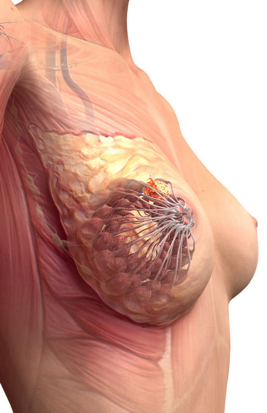 胸,无人,竖图,插画,室内,特写,白天,白色背景,正面,数码,科技,静物,阴影,网络,医学,高光,几何,计算机图形,合成,图画,画,人体,电脑合成图,数码合成图,生物学,肿瘤,乳腺癌,漫画,癌症,生理学,写实,具体,具象,肿瘤细胞,女性,胸部,彩图