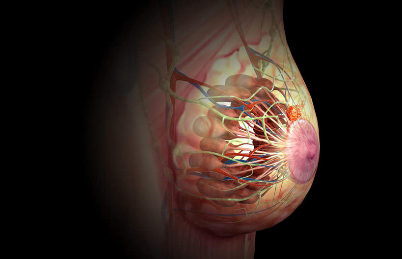 胸,无人,横图,插画,室内,特写,白天,正面,数码,科技,静物,阴影,黑色背景,网络,医学,高光,几何,计算机图形,合成,图画,画,人体,电脑合成图,数码合成图,生物学,肿瘤,乳腺癌,漫画,癌症,生理学,写实,具体,具象,肿瘤细胞,女性,胸部,彩图