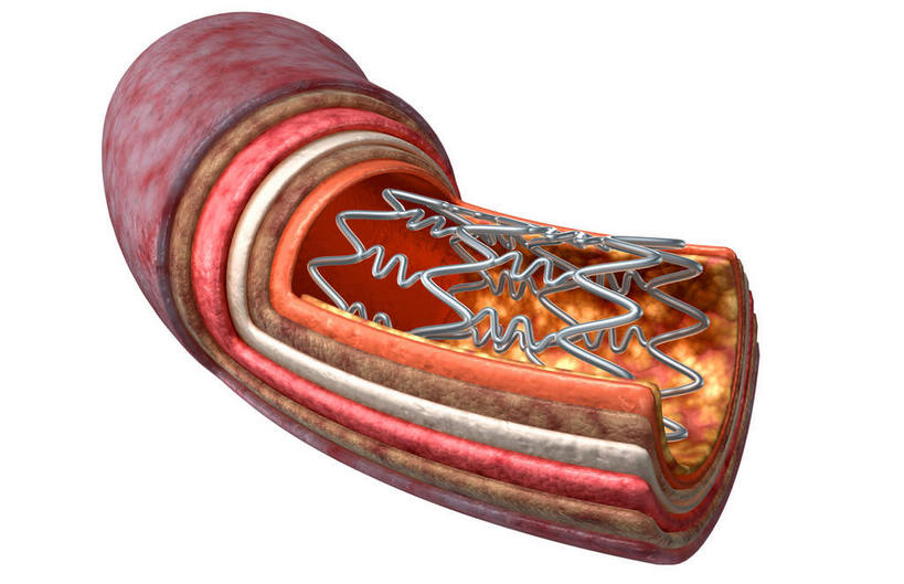 无人,横图,插画,室内,特写,白天,白色背景,正面,数码,科技,静物,阴影,网络,医学,细胞,高光,几何,计算机图形,合成,图画,画,治疗,人体,电脑合成图,数码合成图,疾病,生物学,横截面,漫画,医治,生理学,写实,具体,具象,动脉粥样硬化,彩图