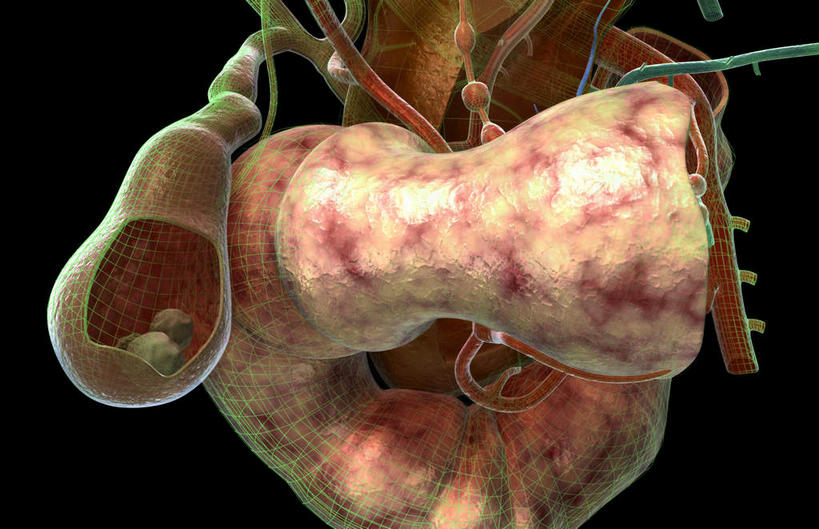 内脏,动脉,静脉,胆囊,无人,横图,插画,室内,特写,白天,正面,数码,科技,石头,静物,阴影,黑色背景,网络,医学,石子,两颗,高光,几何,计算机图形,合成,图画,画,模型,人体,电脑合成图,数码合成图,生物学,人体器官,器官,漫画,生理学,写实,具体,具象,胆,胆结石,结石,石块,彩图