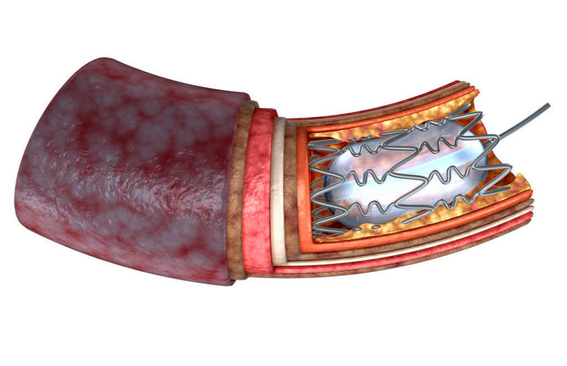 血管,无人,横图,插画,室内,特写,白天,白色背景,正面,数码,科技,静物,阴影,网络,医学,支架,高光,几何,计算机图形,合成,图画,画,治疗,电脑合成图,数码合成图,生物学,漫画,医治,生理学,写实,具体,具象,动脉硬化,动脉粥样硬化,彩图