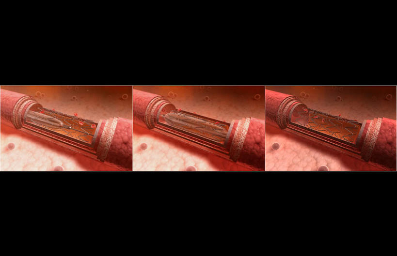 血管,无人,横图,俯视,插画,室内,白天,数码,科技,阴影,过程,网络,医学,材料,高光,几何,计算机图形,合成,图画,画,红色,电脑合成图,数码合成图,疾病,生物学,漫画,进程,原料,生理学,写实,具体,具象,动脉硬化,动脉粥样硬化,血管病,彩图,高角度拍摄