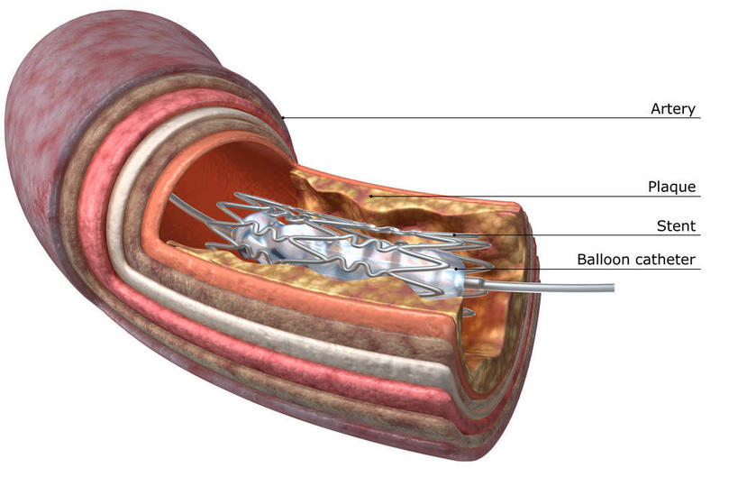 动脉,静脉,血管,无人,横图,插画,室内,特写,白天,白色背景,正面,数码,科技,静物,阴影,网络,医学,英文,标志,文字,字符,字母,高光,几何,计算机图形,合成,图画,标识,画,模型,人体,英文字母,电脑合成图,数码合成图,生物学,漫画,剖面,生理学,写实,具体,具象,动脉硬化,动脉粥样硬化,血管病,彩图