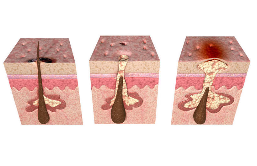 无人,横图,插画,室内,白天,白色背景,正面,数码,科技,静物,阴影,网络,结构,医学,细胞,斑点,高光,几何,计算机图形,构造,合成,图画,画,红色,人体,电脑合成图,数码合成图,生物学,布局,横截面,漫画,毛球,真皮,生理学,写实,具体,具象,毛囊,皮脂,皮脂腺,痤疮,彩图