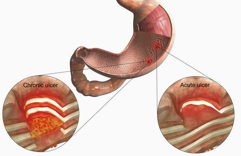 腹部,内脏,胃,动脉,静脉,无人,横图,插画,室内,特写,白天,白色背景,正面,数码,科技,静物,阴影,网络,医学,高光,几何,计算机图形,合成,图画,画,红色,模型,粘液,人体,电脑合成图,数码合成图,疾病,生物学,人体器官,器官,横截面,漫画,生理学,写实,具体,具象,浆膜,消化性溃疡,粘膜下层,胃部,彩图,胃溃疡