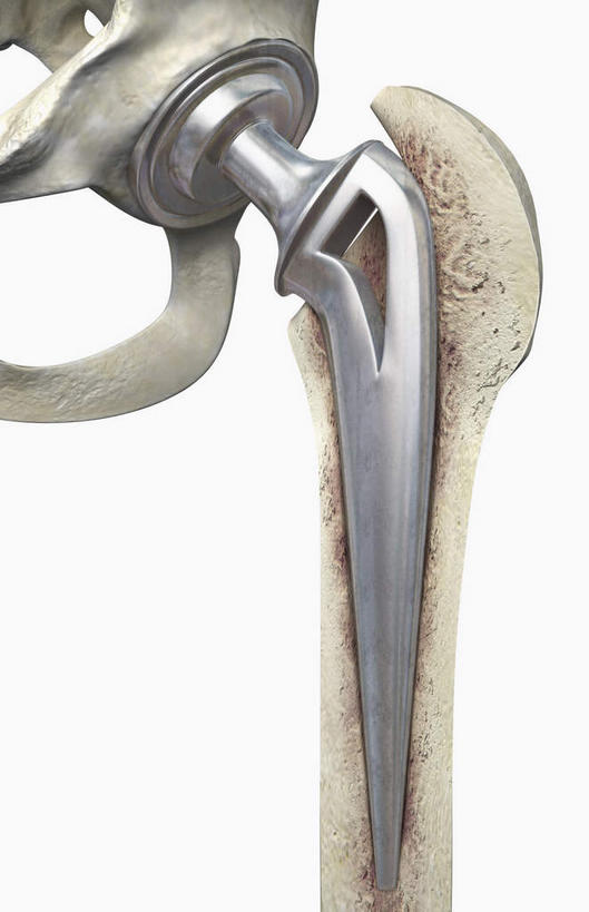 动脉,静脉,骨骼,无人,竖图,插画,室内,特写,白天,白色背景,正面,数码,科技,静物,阴影,局部,网络,医学,骨头,高光,几何,计算机图形,合成,图画,画,模型,人体,电脑合成图,数码合成图,骨架,生物学,髋关节置换,漫画,生理学,写实,具体,具象,髋关节,半身,彩图