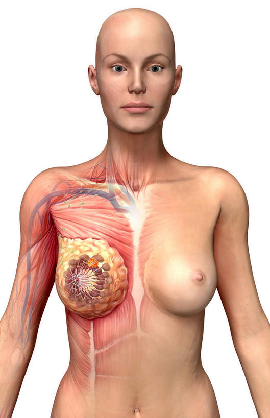 西方人,胸,乳头,秃头,一个人,无人,站,竖图,插画,室内,白天,白色背景,正面,数码,科技,静物,欧洲,欧洲人,仅一个年轻女性,仅一个女性,仅一个人,阴影,网络,医学,细胞,高光,几何,计算机图形,合成,图画,画,站着,人体,电脑合成图,数码合成图,生物学,肿瘤,乳腺癌,漫画,癌症,生理学,写实,具体,具象,年轻女性,女人,女性,白种人,胸部,光头,无发,站立,半身,彩图