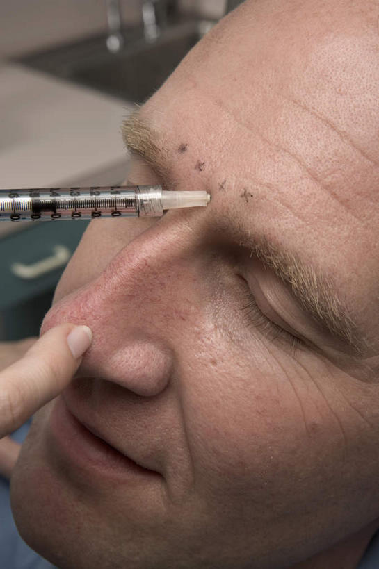 西方人,脸,头,脸颊,手,两个人,医生,病人,站,躺,闭眼,竖图,俯视,室内,特写,白天,欧洲,欧洲人,握,拿,拿着,站着,医护人员,医疗人员,手部,针管,针筒,握着,注射,医疗,医疗设备,注射器,病患,肉毒杆菌,麻醉剂,肉毒杆菌毒素,卧着,男人,男性,女人,女性,中年男性,中年女性,白种人,头部,脸部,脸蛋,面部,大夫,患者,就医者,闭眼睛,闭着眼,闭着眼睛,躺着,卧,站立,半身,彩图,高角度拍摄,肉毒毒素,神经毒素,生物毒素