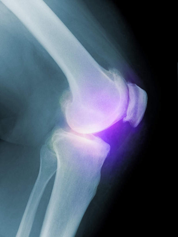 膝关节,无人,竖图,插画,x光片,室内,特写,白天,正面,数码,科技,阴影,黑色背景,辐射,科学,网络,医学,高光,几何,计算机图形,合成,图画,画,红色,电脑合成图,数码合成图,医疗,科学技术,x射线,x光,漫画,写实,具体,具象,彩图,电磁波,电磁辐射