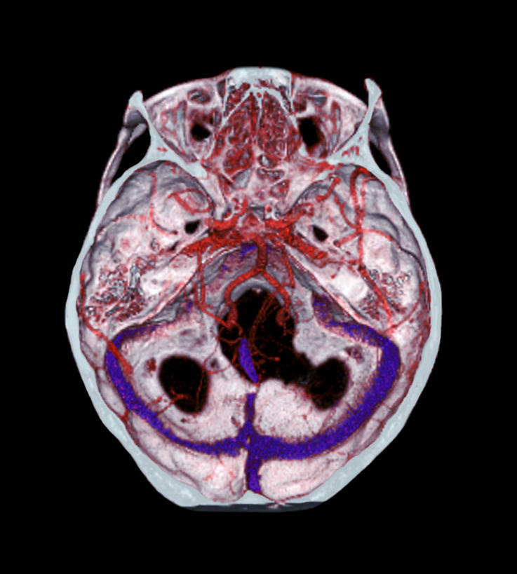 血管,毛细血管,无人,竖图,插画,x光片,室内,白天,正面,数码,科技,大脑,阴影,黑色背景,辐射,科学,网络,医学,纹路,纹理,高光,几何,计算机图形,合成,图画,画,电脑合成图,数码合成图,医疗,科学技术,x射线,器官,合成图,沟壑,x光,漫画,小脑,脑干,肌理,写实,具体,具象,大脑皮层,端脑,沟,灰质,回,间脑,彩图,电磁波,电磁辐射