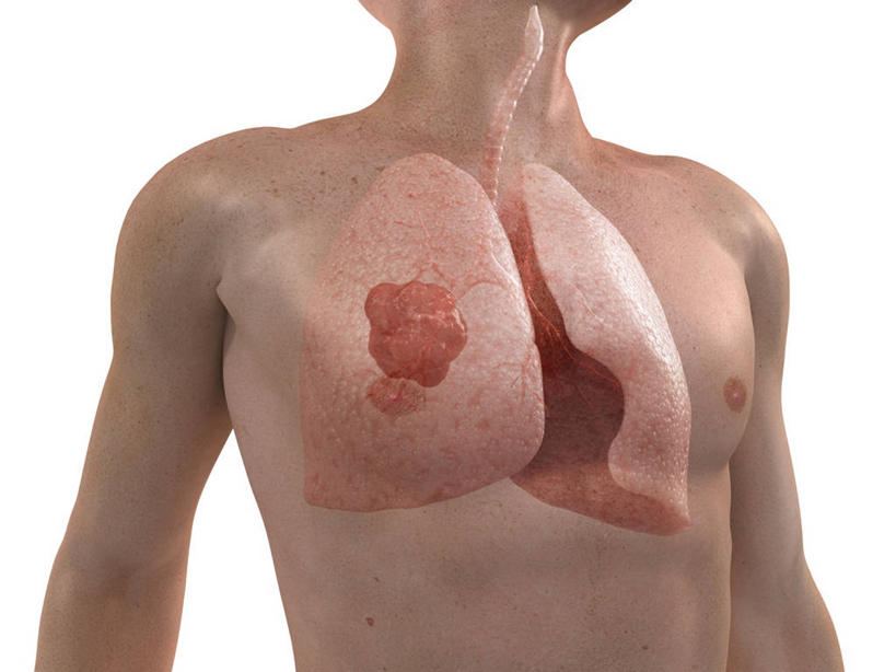 内脏,肺,动脉,静脉,一个人,无人,站,横图,插画,室内,白天,白色背景,正面,数码,科技,仅一个男性,仅一个人,阴影,科学,网络,医学,高光,几何,计算机图形,合成,图画,裸露,画,仅一个年轻男性,站着,人体,赤裸,电脑合成图,数码合成图,疾病,生物学,人体器官,器官,合成图,肿瘤,裸,漫画,癌症,写实,具体,具象,恶性肿瘤,肺癌,自然科学,博物学,生物科学,男人,男性,年轻男性,肺部,肺脏,站立,半身,彩图,肺肿瘤