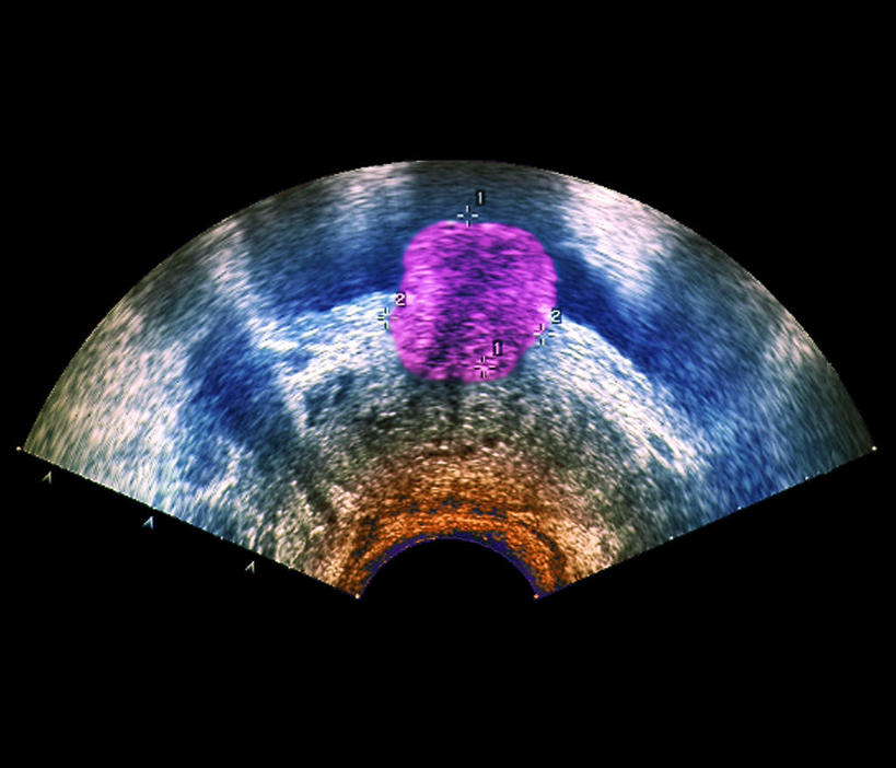 骨盆,无人,横图,插画,室内,白天,正面,数码,科技,一把,阴影,黑色背景,网络,高光,几何,计算机图形,合成,图画,画,扇形,电脑合成图,数码合成图,肿瘤,漫画,泌尿系统,前列腺,写实,具体,具象,彩图,男性生殖器,生殖器