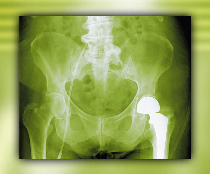 无人,横图,x光片,室内,白天,正面,发光,辐射,科学,医学,绿色,医疗,科学技术,x射线,x光,髋关节,彩图,电磁波,电磁辐射