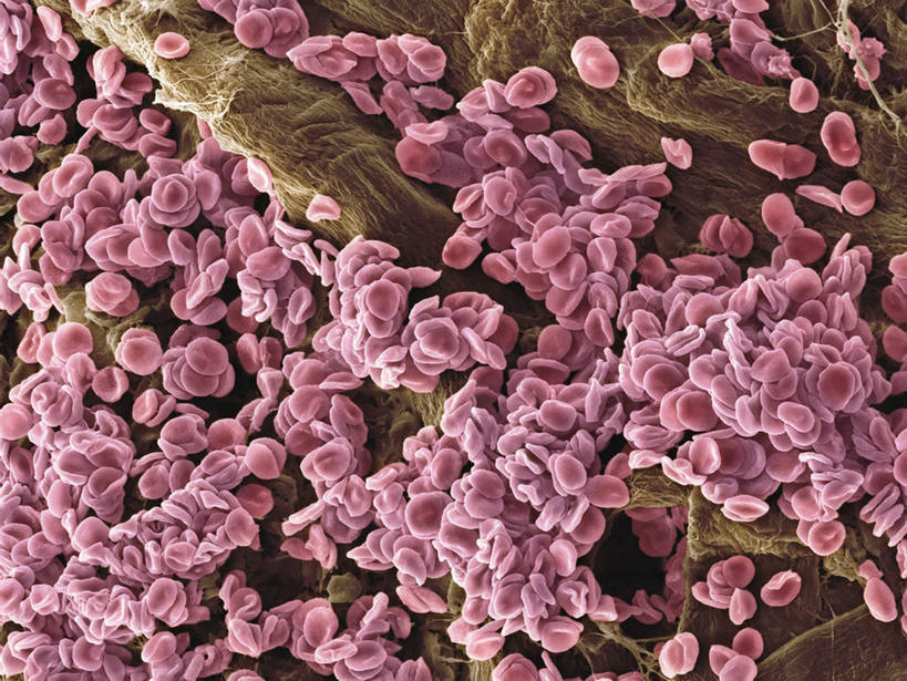 无人,横图,室内,特写,白天,正面,数码,科技,静物,阴影,网络,红血球,医学,细胞,高光,几何,计算机图形,合成,粉色,人体,电脑合成图,数码合成图,生物学,血细胞,不幸,癌症,可怜,生理学,写实,具体,具象,红细胞,白血病,红血细胞,血癌,肿瘤细胞,彩图