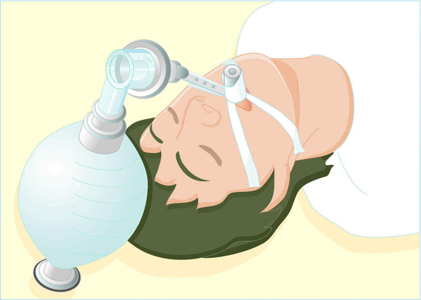 东方人,一个人,无人,病人,躺,闭眼,横图,俯视,插画,室内,白天,白色背景,工作服,制服,数码,科技,亚洲,仅一个男性,仅一个人,阴影,网络,高光,几何,计算机图形,合成,图画,黄种人,画,仅一个年轻男性,呼吸器,电脑合成图,数码合成图,漫画,写实,具体,具象,工作制服,卧着,男人,男性,年轻男性,亚洲人,患者,就医者,闭眼睛,闭着眼,闭着眼睛,躺着,卧,半身,彩图,高角度拍摄,工作套服