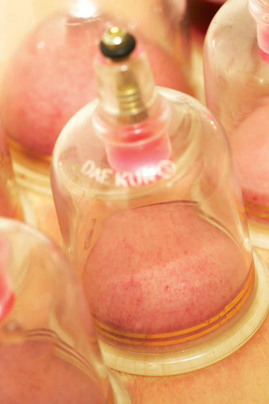 东方人,一个人,竖图,俯视,室内,特写,白天,玻璃,亚洲,仅一个男性,仅一个人,阴影,反射,医学,影子,黄种人,文化,玻璃制品,仅一个年轻男性,容器,趴着,治疗,保健,储藏,医疗,储存,中国文化,拔火罐,中医,火罐,医治,拔罐,拔罐疗法,拔罐子,火罐疗法,中医学,男人,男性,年轻男性,亚洲人,趴,半身,彩图,高角度拍摄,贮存,传统文化