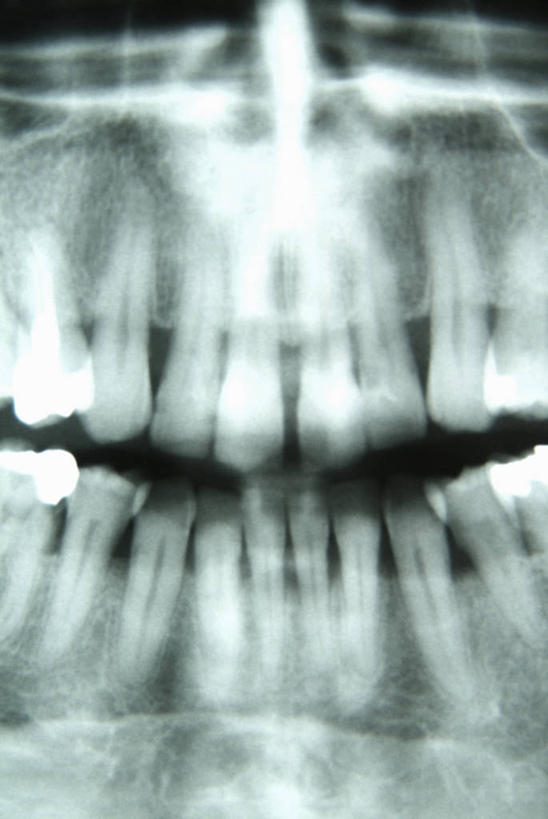 牙齿,无人,竖图,x光片,室内,特写,白天,正面,静物,辐射,科学,医学,医疗,科学技术,x射线,假牙,x光,活动假牙,义齿,齿,牙,牙龈,彩图,电磁波,电磁辐射