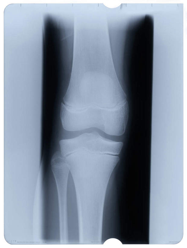 腿部,关节,腿,无人,竖图,x光片,室内,特写,白天,正面,静物,辐射,科学,医学,医疗,科学技术,x射线,x光,彩图,电磁波,电磁辐射