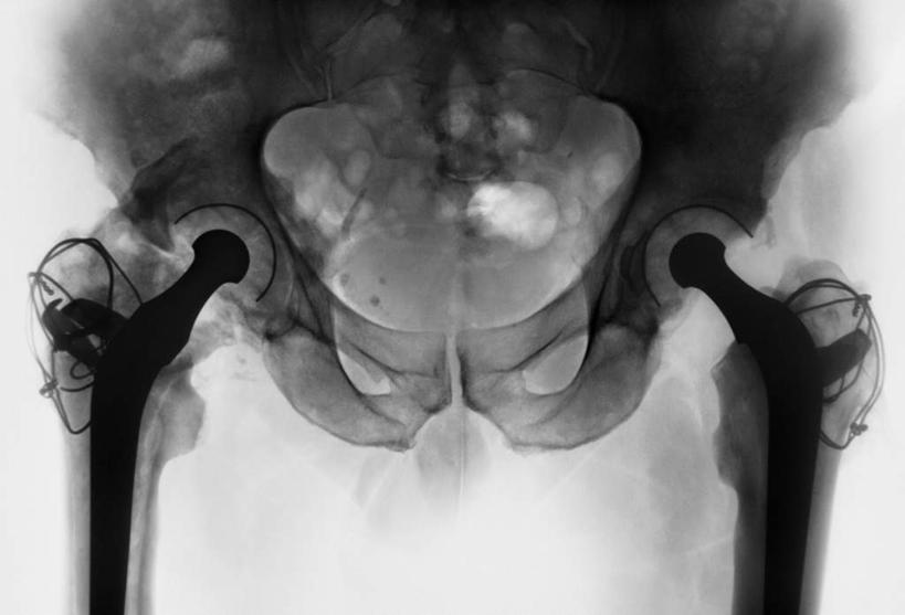 骨骼,骨盆,无人,横图,x光片,室内,特写,白天,白色背景,正面,静物,辐射,科学,医学,钉子,骨头,骨架,五金,医疗,科学技术,x射线,紧固,x光,牢固,骶骨,髋骨,尾骨,胯骨,彩图,稳固,电磁波,电磁辐射