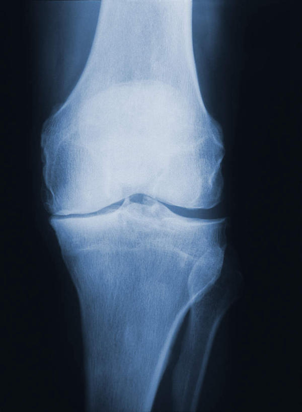 膝盖,骨骼,关节,无人,竖图,x光片,室内,特写,白天,正面,静物,黑色背景,辐射,科学,医学,骨头,骨架,医疗,科学技术,x射线,腿骨,x光,彩图,电磁波,电磁辐射