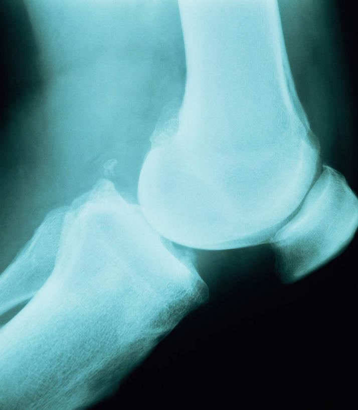 骨骼,关节,无人,竖图,x光片,室内,白天,正面,黑色背景,辐射,科学,医学,骨头,骨架,医疗,科学技术,x射线,x光,彩图,电磁波,电磁辐射