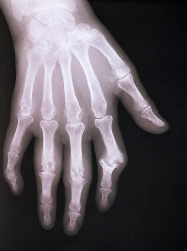骨骼,无人,竖图,x光片,室内,特写,白天,正面,静物,黑色背景,辐射,科学,医学,骨头,骨架,医疗,科学技术,x射线,x光,尺骨,肱骨,桡骨,腕骨,掌骨,指骨,彩图,电磁波,电磁辐射