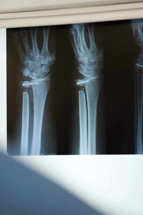 手,手腕,无人,医院,竖图,x光片,室内,特写,白天,正面,静物,照明,一张,辐射,科学,医学,灯光,骨头,灯,一只,灯具,手部,灯箱,照亮,医疗,科学技术,x射线,照明设备,x光,医疗机构,彩图,病院,诊所,电磁波,电磁辐射