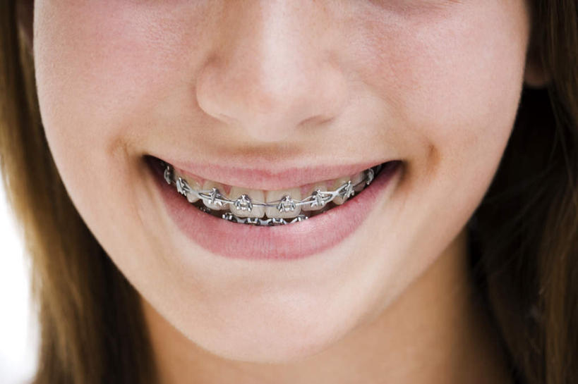 西方人,脸,头,鼻子,嘴,脸颊,一个人,横图,室内,特写,白天,白色背景,正面,欧洲,欧洲人,仅一个年轻女性,仅一个女性,仅一个人,注视,模型,观察,看,摄影,影棚,模具,观看,察看,关注,矫正,牙科,牙套,牙箍,校正,校准,牙饰,年轻女性,女人,女性,白种人,头部,鼻,鼻孔,口,口腔,脸部,脸蛋,面部,嘴巴,嘴唇,半身,彩图,影棚拍摄,拍摄