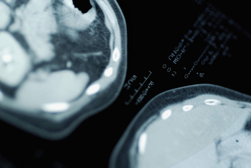 无人,横图,俯视,x光片,室内,特写,白天,机器,静物,大脑,朦胧,模糊,辐射,科学,医学,设备,医疗,科学技术,x射线,器官,沟壑,x光,核磁共振,核磁共振成像,小脑,脑干,大脑皮层,端脑,沟,灰质,回,间脑,磁共振成像,核磁共振技术,彩图,高角度拍摄,电磁波,电磁辐射