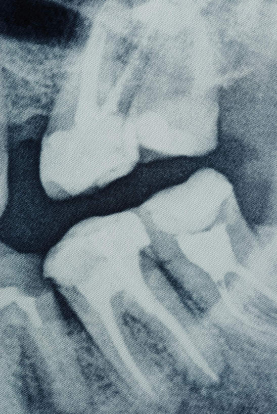 牙齿,无人,竖图,x光片,室内,特写,白天,正面,辐射,科学,医学,医疗,科学技术,x射线,x光,齿,牙,牙龈,彩图,电磁波,电磁辐射