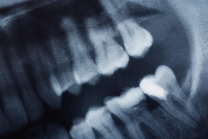 牙齿,无人,横图,x光片,室内,特写,白天,正面,静物,阴影,反射,辐射,科学,医学,影子,医疗,科学技术,x射线,x光,齿,牙,牙龈,彩图,电磁波,电磁辐射