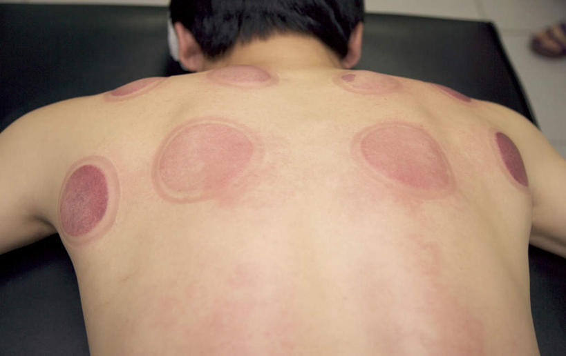 东方人,一个人,横图,俯视,室内,特写,白天,亚洲,仅一个男性,仅一个人,医学,罐子,黄种人,文化,玻璃制品,仅一个年轻男性,玻璃瓶,瓶子,趴着,治疗,保健,后背,医疗,中国文化,拔火罐,中医,火罐,医治,拔罐,拔罐疗法,拔罐子,火罐疗法,中医学,男人,男性,年轻男性,亚洲人,趴,半身,彩图,高角度拍摄,传统文化