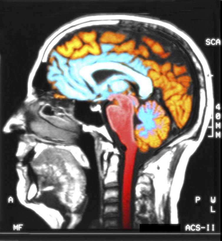 头,无人,竖图,x光片,室内,特写,白天,正面,大脑,阴影,辐射,光线,科学,医学,影子,灯光,医疗,科学技术,x射线,器官,沟壑,x光,小脑,脑干,大脑皮层,端脑,沟,灰质,回,间脑,头部,彩图,电磁波,电磁辐射