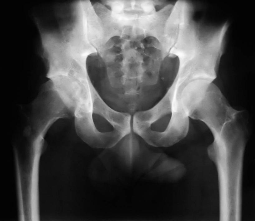 成年人,骨盆,一个人,横图,x光片,仅一个男性,辐射,科学,医学,骨头,摄影,臀,医疗,科学技术,x射线,x光,男人,脊柱,彩图,电磁波,电磁辐射