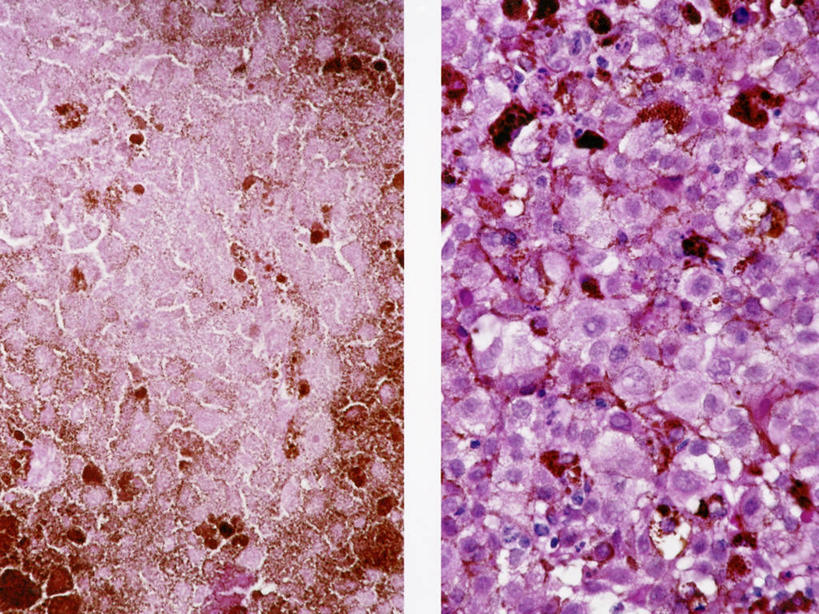 无人,横图,科学,比较,摄影,放大,癌症,微生物学,彩图,黑色素瘤
