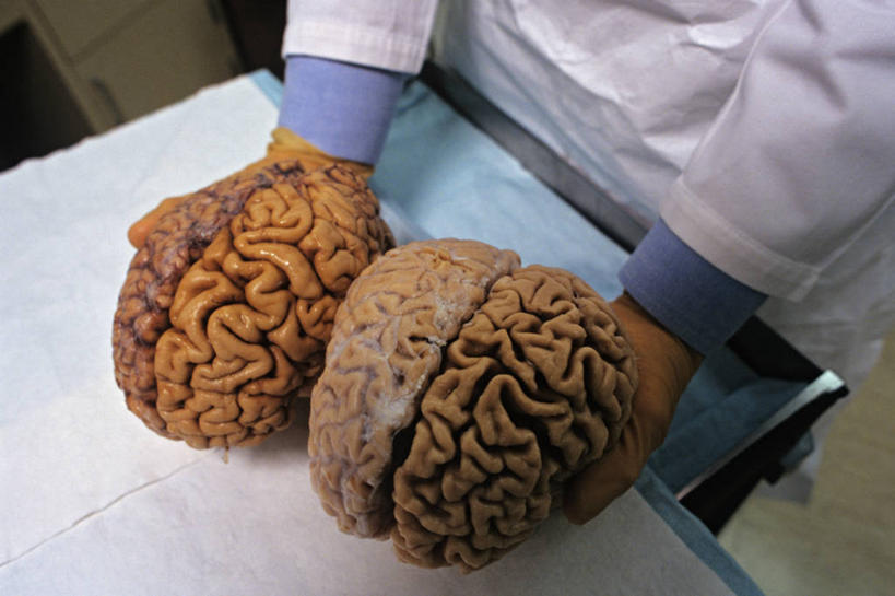 皱纹,一个人,横图,室内,美国,研究,折叠,拿着,白色,生病,摄影,肯塔基州,老年痴呆症,彩图,脑膜