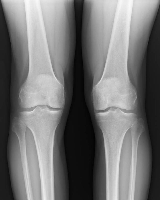 腿,一个人,竖图,黑白,x光片,特写,大腿,辐射,科学,医学,骨头,摄影,部分,医疗,科学技术,x射线,x光,腓骨,股骨,胫骨,四肢,人体结构,电磁波,电磁辐射