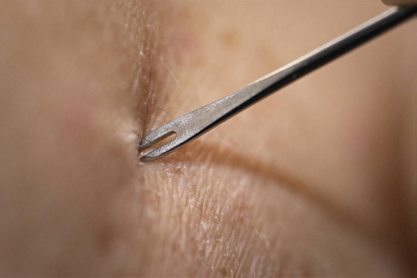 一个人,横图,室外,朦胧,模糊,叉,生病,注射,摄影,皮肤,注射器,斯普利特,彩图,天花病毒,门诊部,接种疫苗