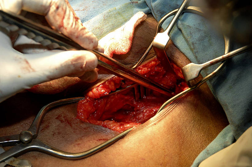 手,一个人,医院,横图,室内,特写,白天,安全,苏丹,镊子,防护,手套,纸巾,血液,摄影,保护,协助,部分,手术,伤口,手术室,准确,保险,外科医生,保全,周全,安稳,安定,防护手套,技能,平安,彩图