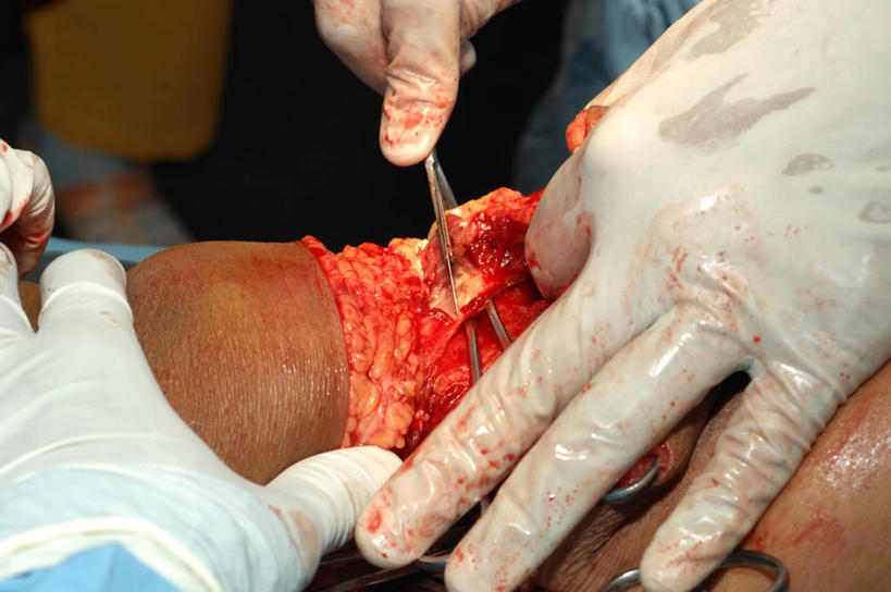 肌肉,腿,健壮,三个人,病人,医院,横图,室内,特写,安全,镊子,防护,拿着,手套,健康,血液,活力,力量,治疗,摄影,青春,保护,部分,手术,医疗,手术室,开刀,强壮,病患,保险,切断,医疗工具,外科医生,保全,周全,安稳,安定,防护手套,四头肌,四肢,平安,患者,就医者,彩图,外科手术