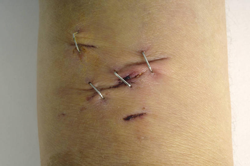 手腕,关节,一个人,横图,特写,白色背景,摄影,部分,伤口,自杀,切断,四肢,钉书钉,手臂,彩图,影棚拍摄