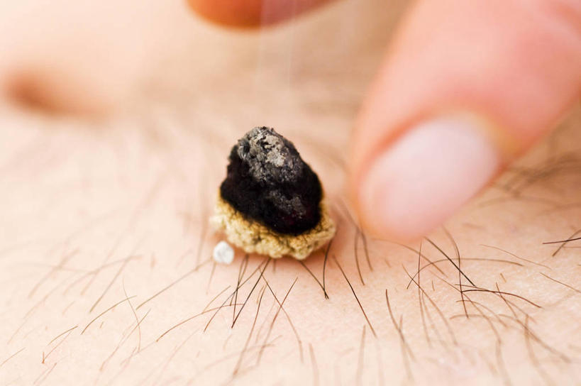 成年人,头发,两个人,病人,横图,室内,特写,白天,燃烧,英格兰,裸露,手指,摄影,皮肤,裸,针灸,替代疗法,艾蒿,艾灸,触摸,彩图,全画面,全框架,全帧,全画幅,对焦