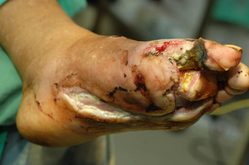 腿部,脚,脚趾,脚趾甲,腿,一个人,病人,横图,室内,特写,苏丹,治疗,摄影,部分,手术,医疗,手术室,开刀,病患,足,败血病,四肢,糖尿病,脚指甲,患者,就医者,彩图,外科手术