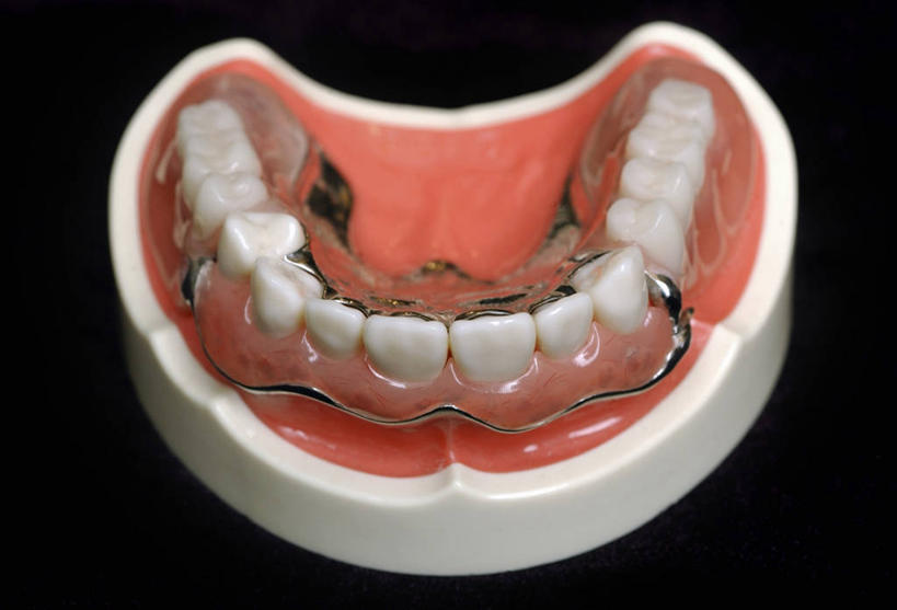 牙齿,无人,横图,吊带,黑色背景,金属,一个,摄影,单个,假牙,齿,牙,牙龈,彩图,影棚拍摄