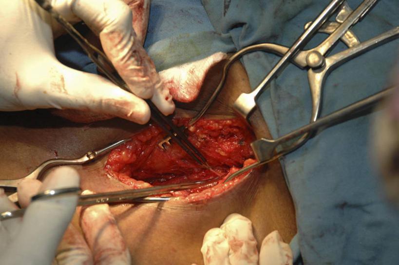 脖子,手,内脏,动脉,静脉,四个人,横图,俯视,室内,特写,安全,不锈钢,科学,医学,防护,手套,人体,摄影,保护,部分,手术,生物学,人体器官,手术室,器官,保险,医疗工具,腺体,外科医生,保全,周全,安稳,安定,防护手套,甲状腺,自然科学,博物学,生物科学,平安,彩图,高角度拍摄