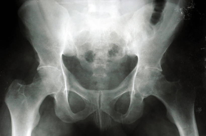 骨骼,关节,无人,横图,x光片,苏丹,辐射,科学,医学,摄影,臀,部分,手术,医疗,科学技术,x射线,x光,整形,软骨,股骨,骨质疏松症,彩图,外科手术,医疗美容外科手术,整形手术,电磁波,电磁辐射